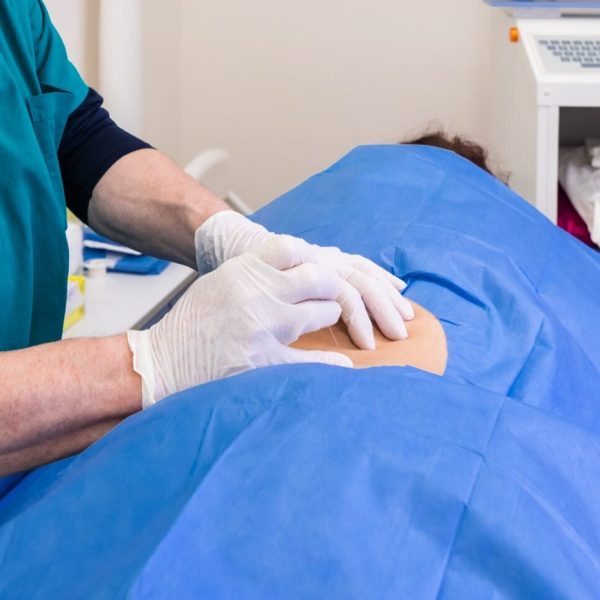 Doctor practices the infiltration of drugs to the patient in the area affected by the pain, using the ultrasound support to visualize the anatomical components of the spine.